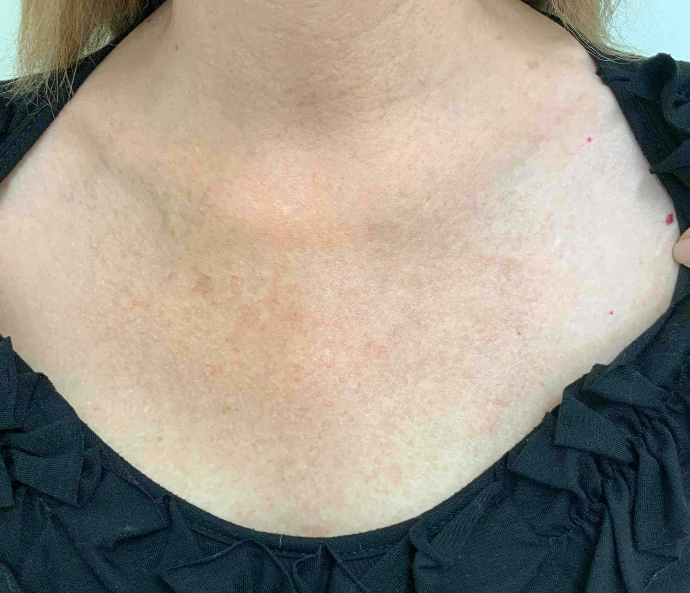 BBL™ Laser Before & After Gallery - Patient 263680 - Image 2