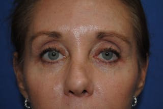 ThermiTight™ Before & After Gallery - Patient 346307 - Image 4