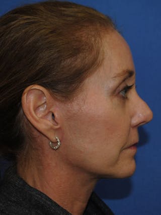 ThermiTight™ Before & After Gallery - Patient 346307 - Image 6