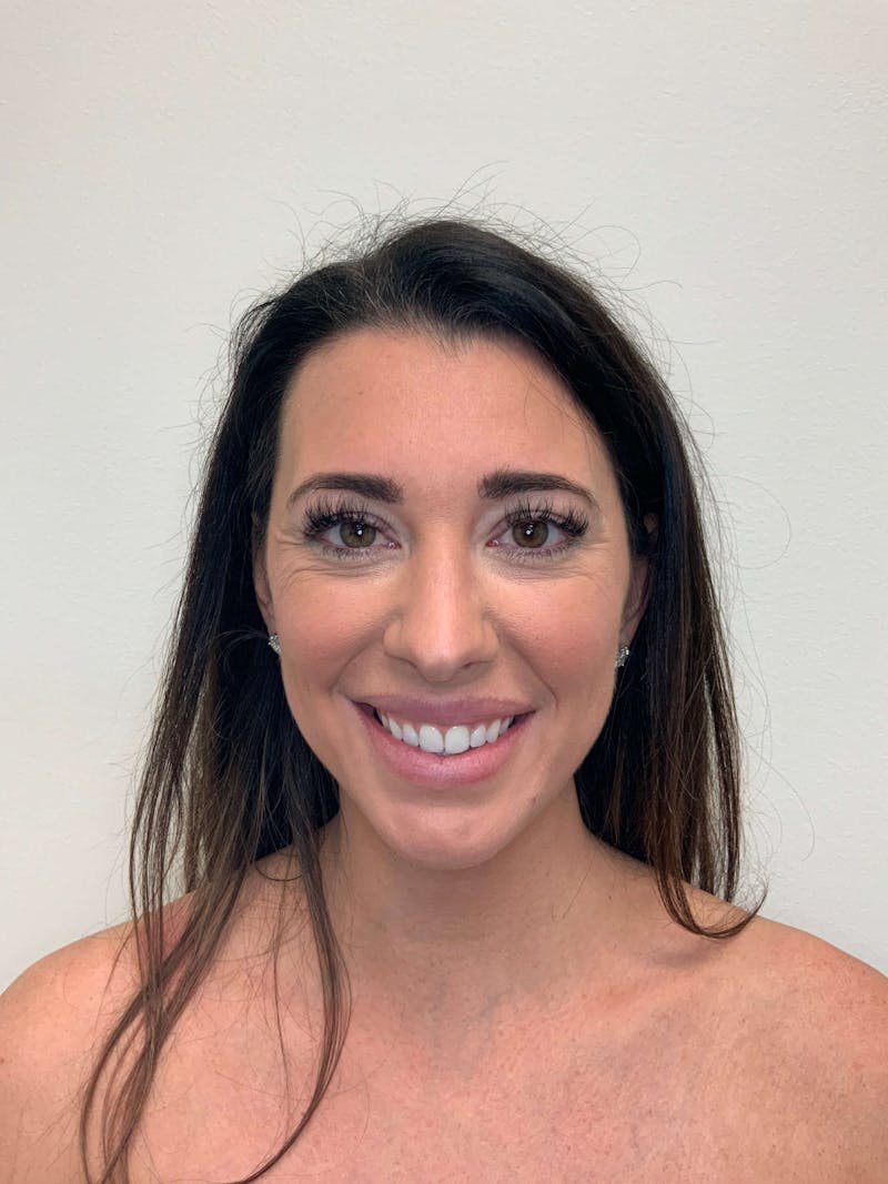 Juvéderm® Before & After Gallery - Patient 366370 - Image 1