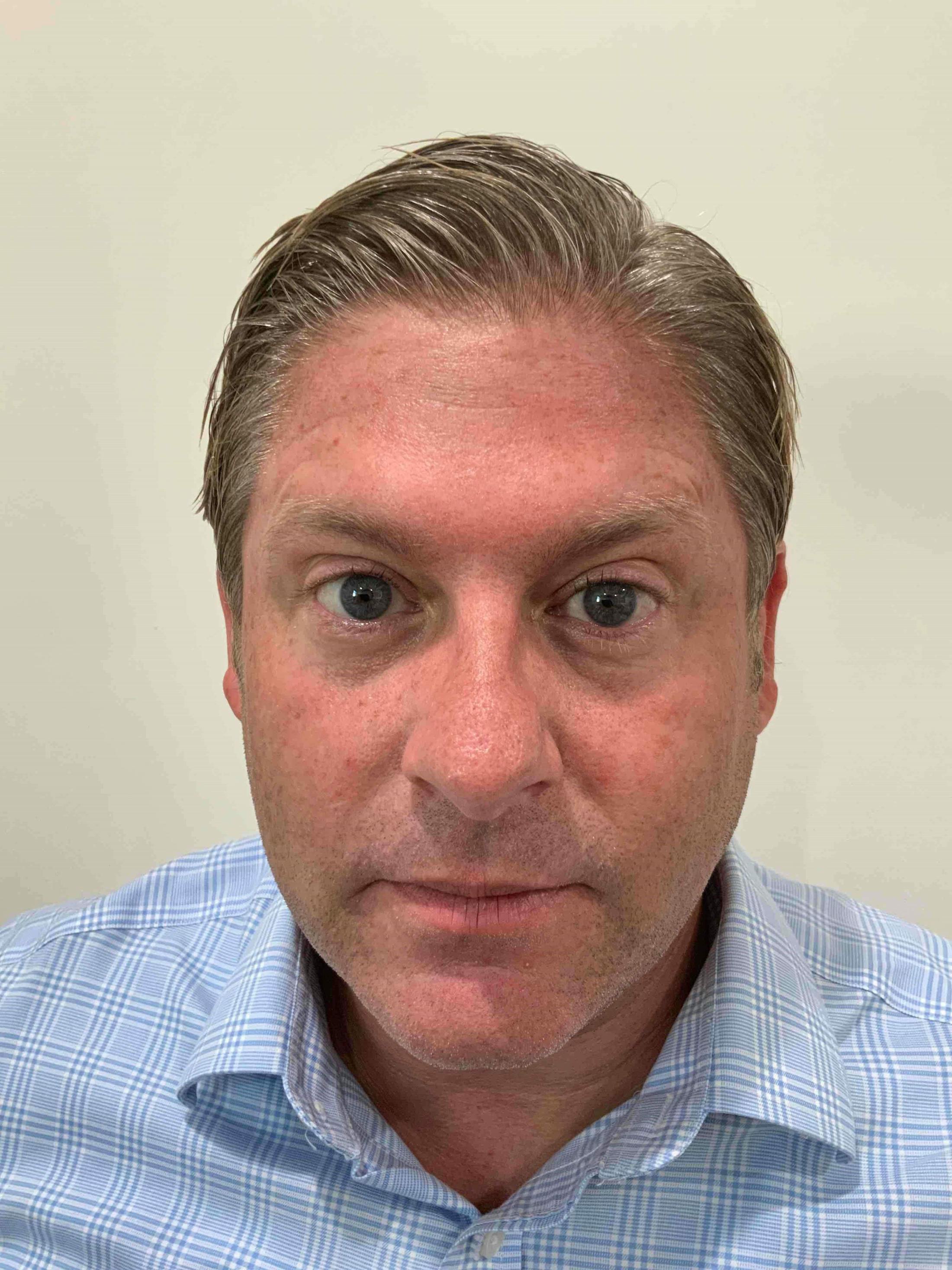 BOTOX® Before & After Gallery - Patient 178290 - Image 2