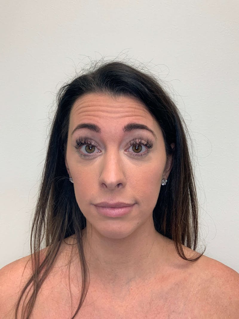 Juvéderm® Before & After Gallery - Patient 366370 - Image 3