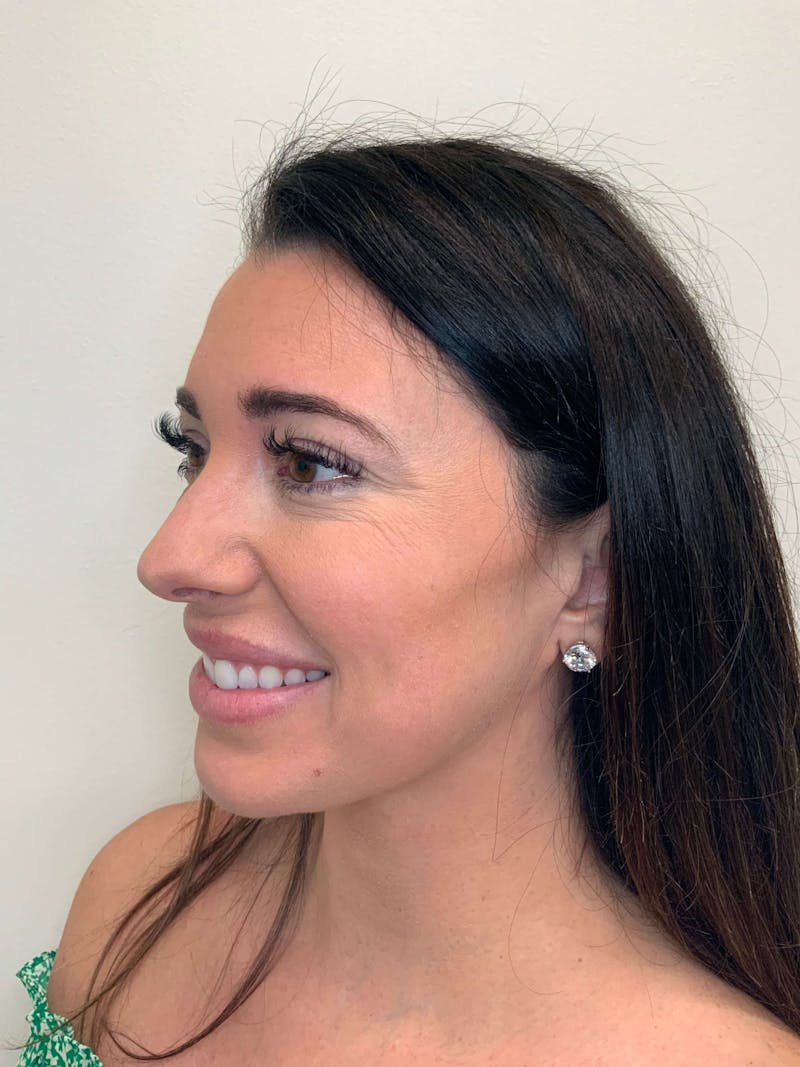 Juvéderm® Before & After Gallery - Patient 366370 - Image 7