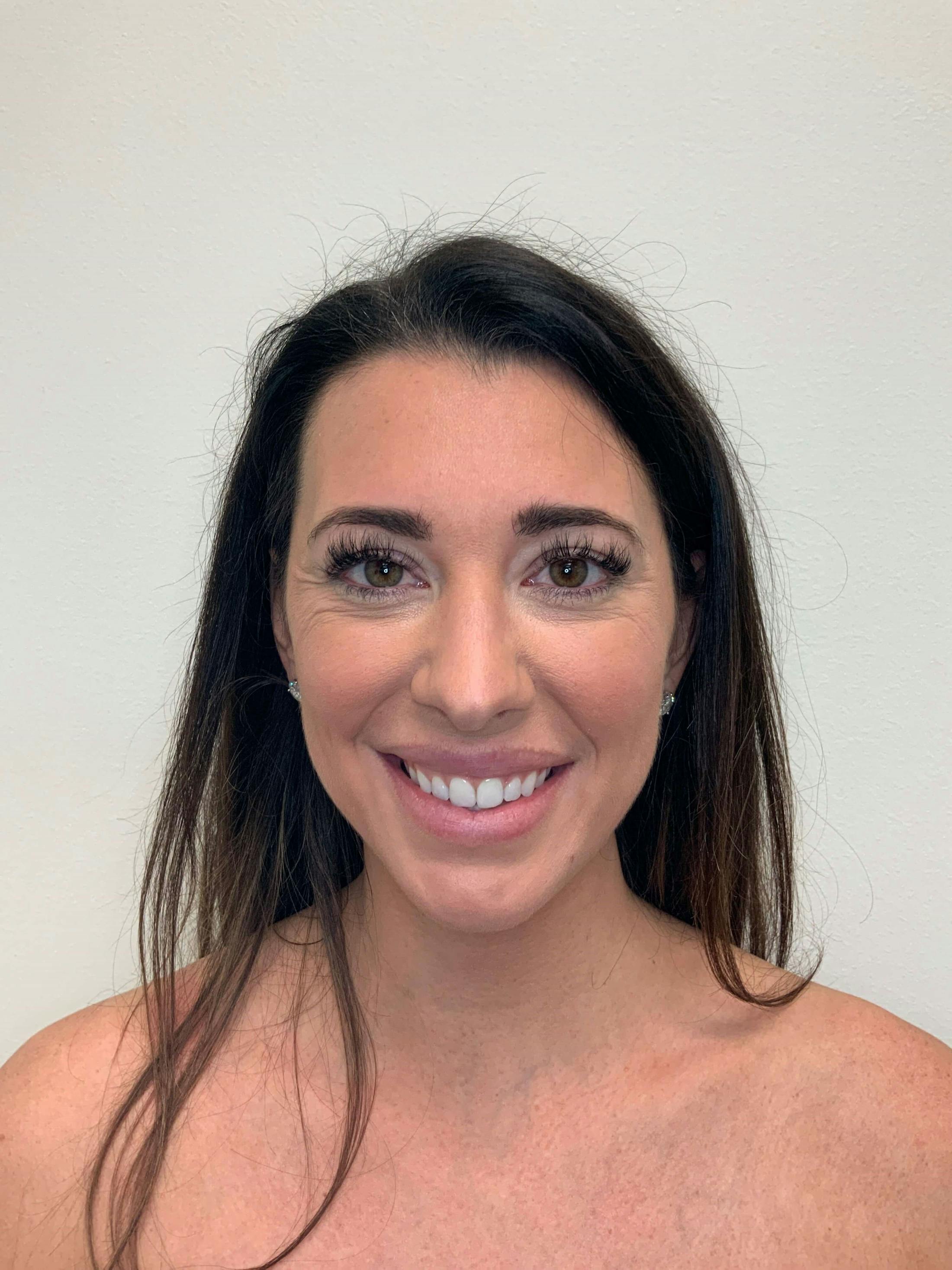 BOTOX® Before & After Gallery - Patient 694026 - Image 1