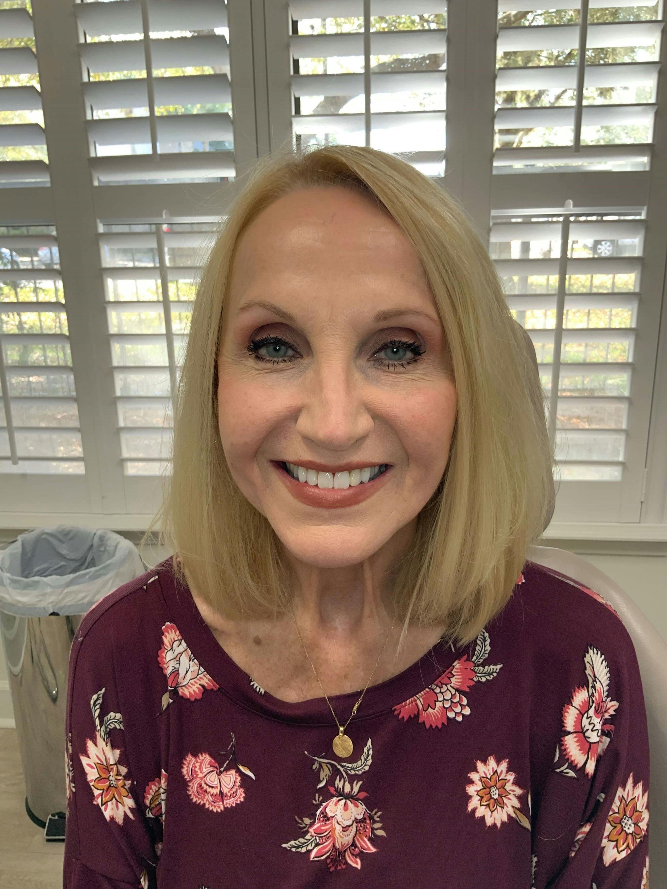 Juvéderm® Before & After Gallery - Patient 491343 - Image 2