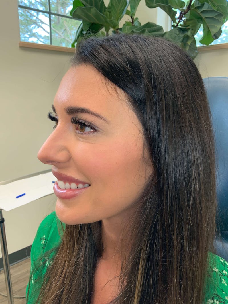BOTOX® Before & After Gallery - Patient 694026 - Image 8