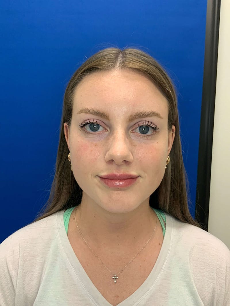 Juvéderm® Before & After Gallery - Patient 446534 - Image 2