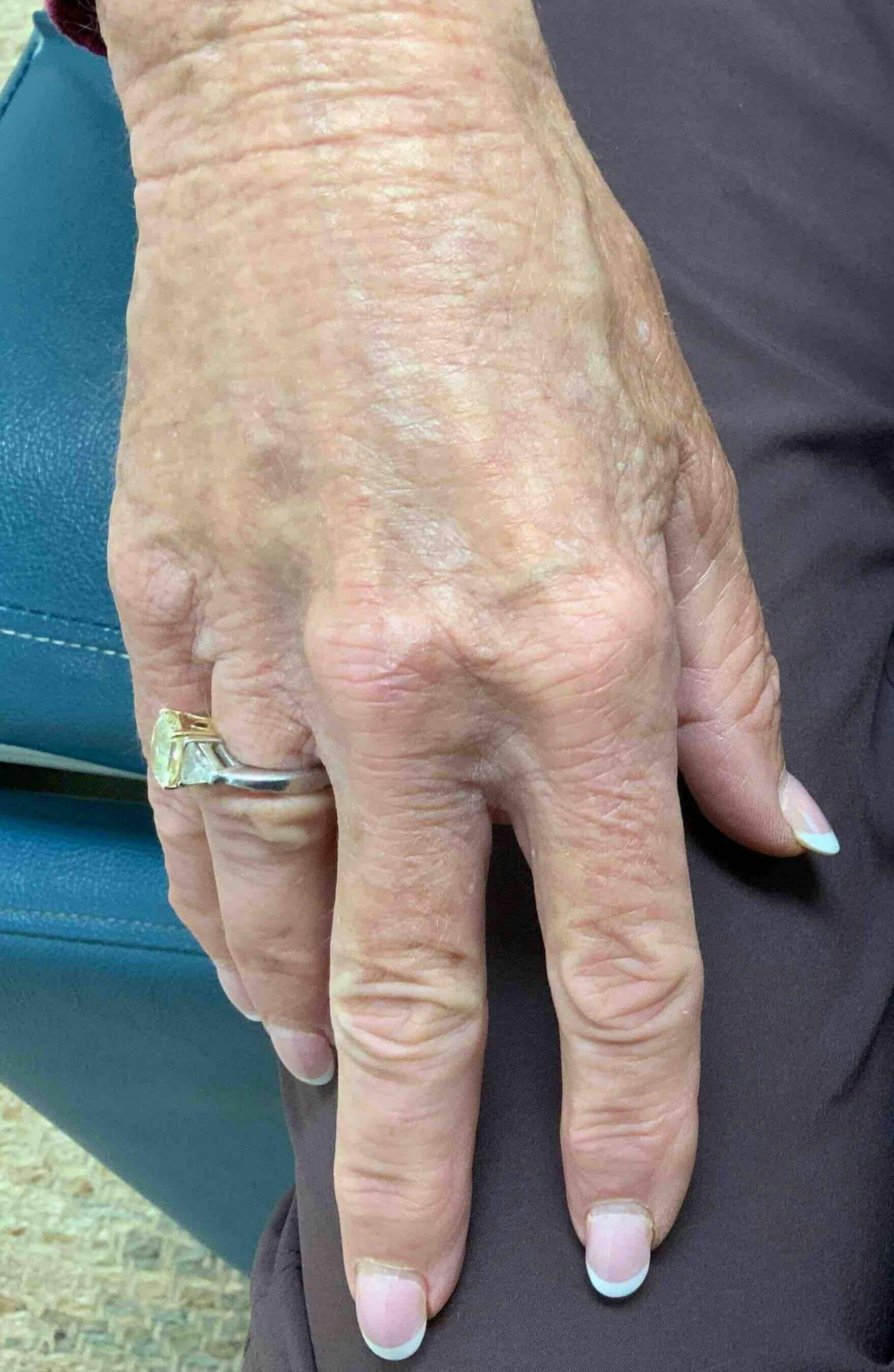 Restylane® Before & After Gallery - Patient 426313 - Image 2