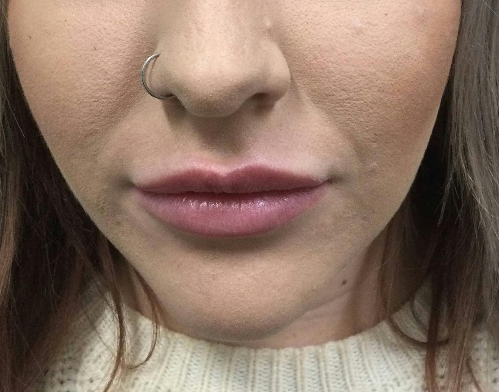 Restylane® Before & After Gallery - Patient 362444 - Image 1