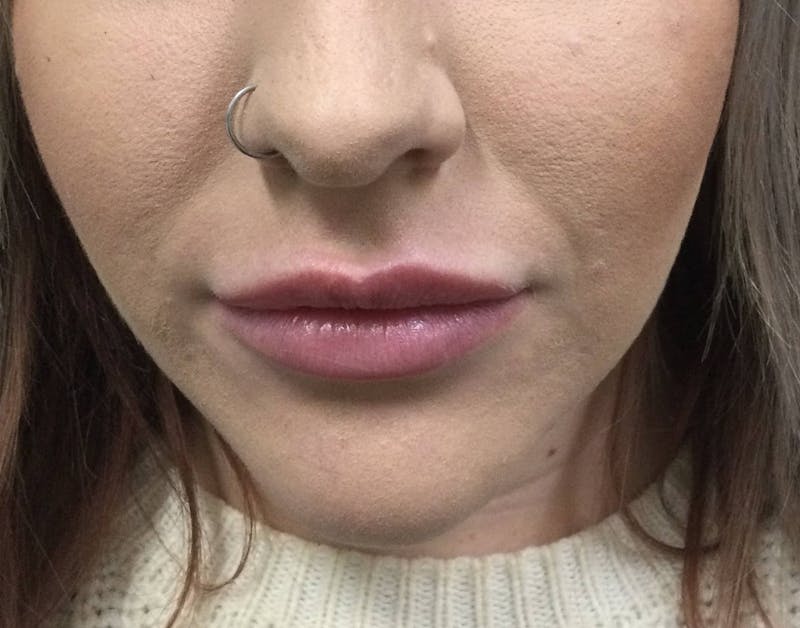 Restylane® Before & After Gallery - Patient 362444 - Image 1