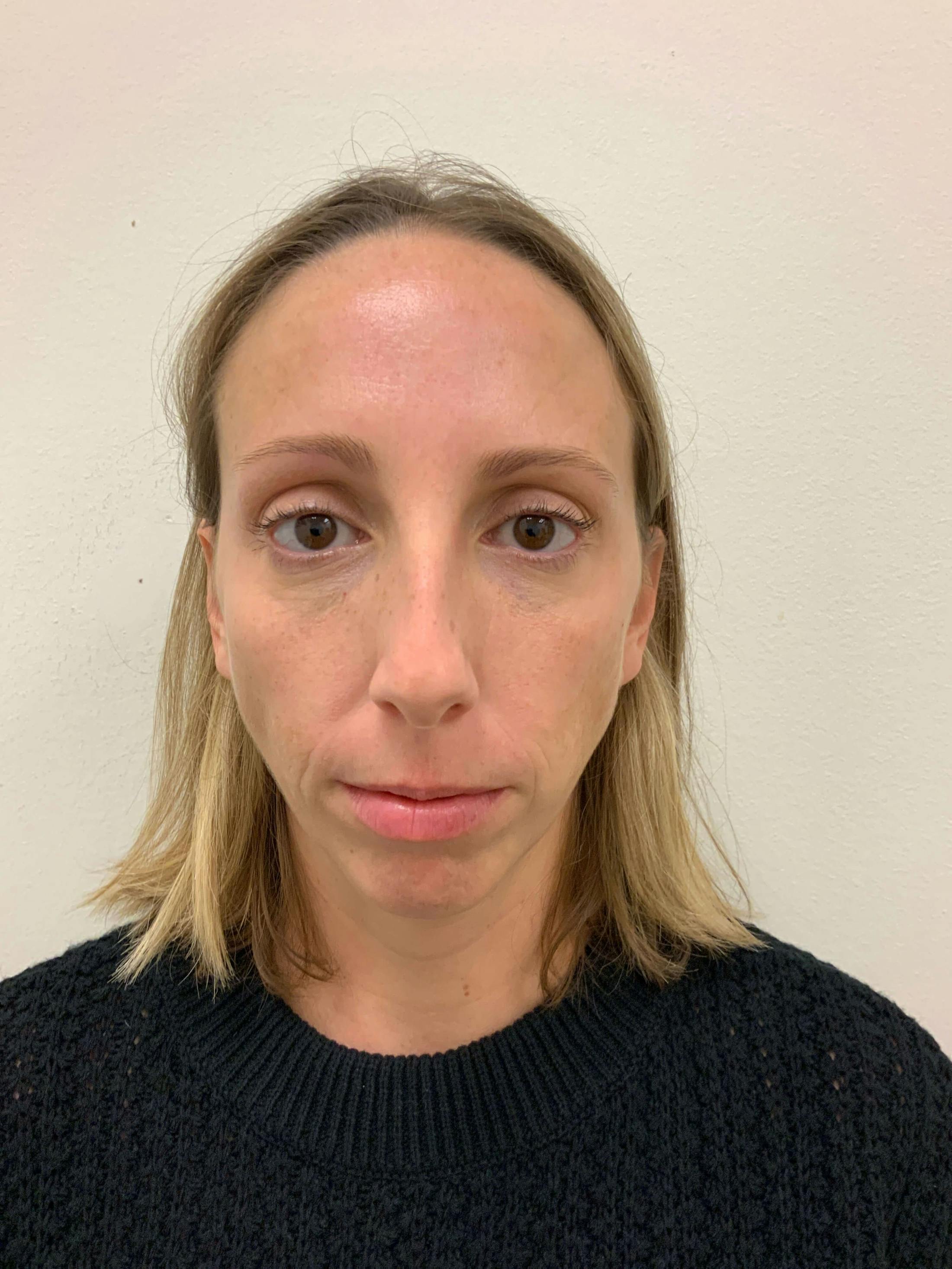 BOTOX® Before & After Gallery - Patient 865926 - Image 1