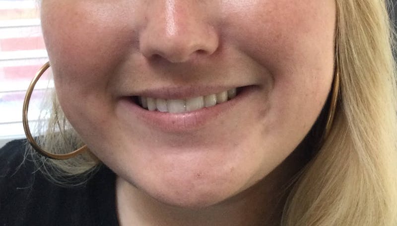 Restylane® Before & After Gallery - Patient 167789 - Image 1
