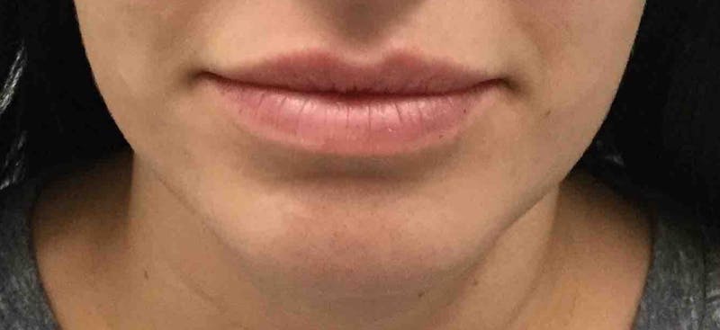 Juvéderm® Before & After Gallery - Patient 331085 - Image 1