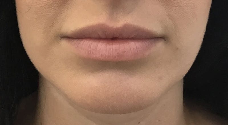 Juvéderm® Before & After Gallery - Patient 331085 - Image 2