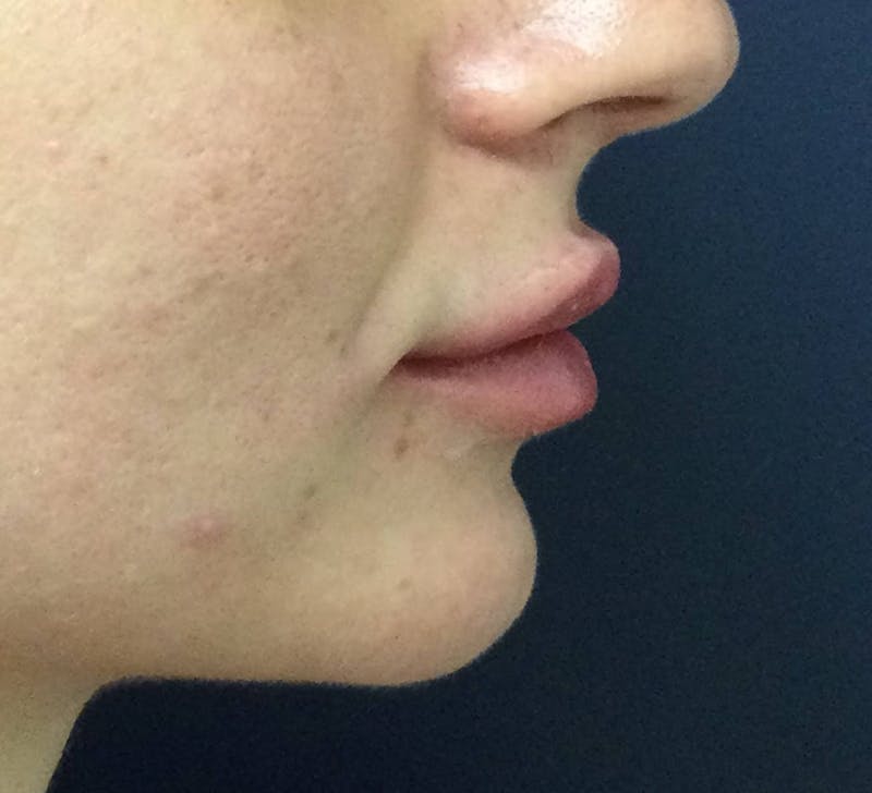 Restylane® Before & After Gallery - Patient 119047 - Image 4