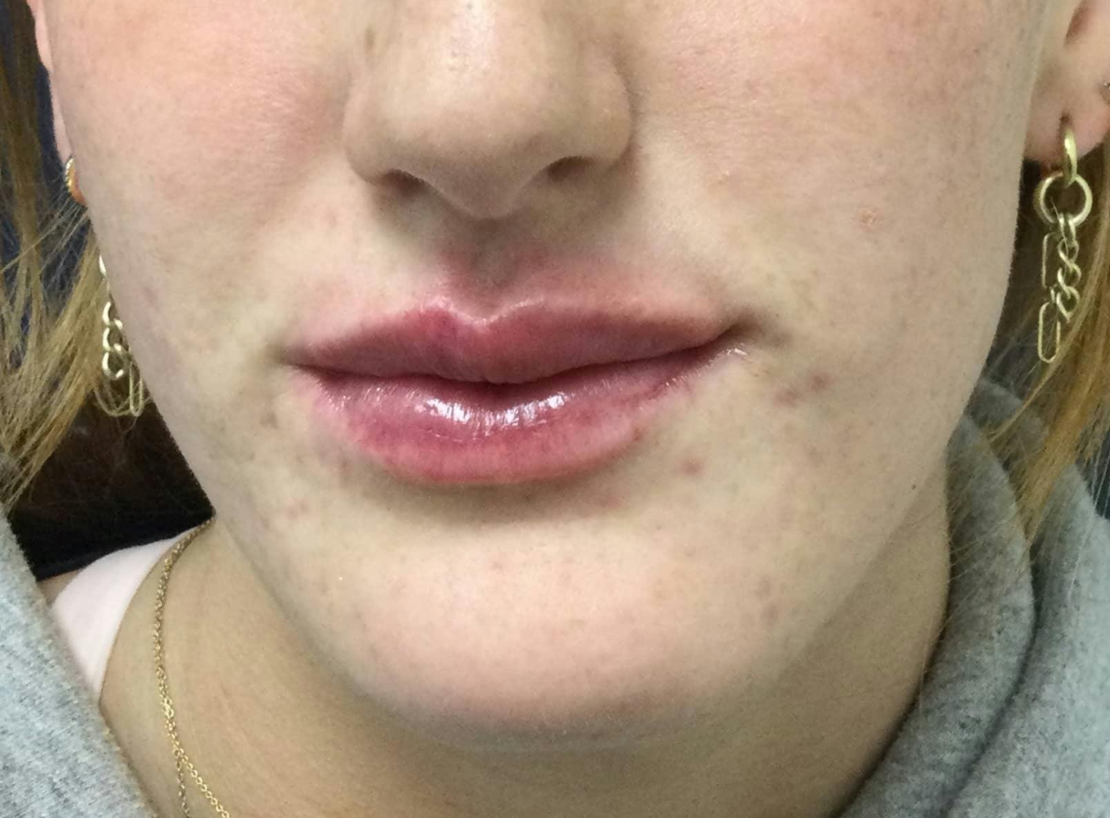 Restylane® Before & After Gallery - Patient 272494 - Image 2