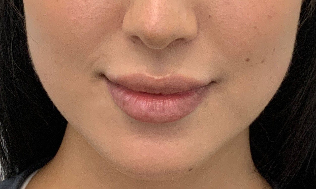 Juvéderm® Before & After Gallery - Patient 313205 - Image 2