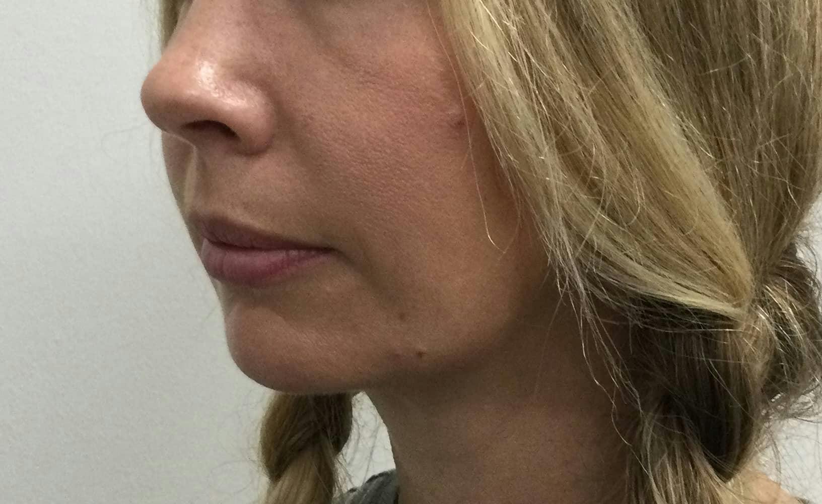 Restylane® Before & After Gallery - Patient 384756 - Image 1