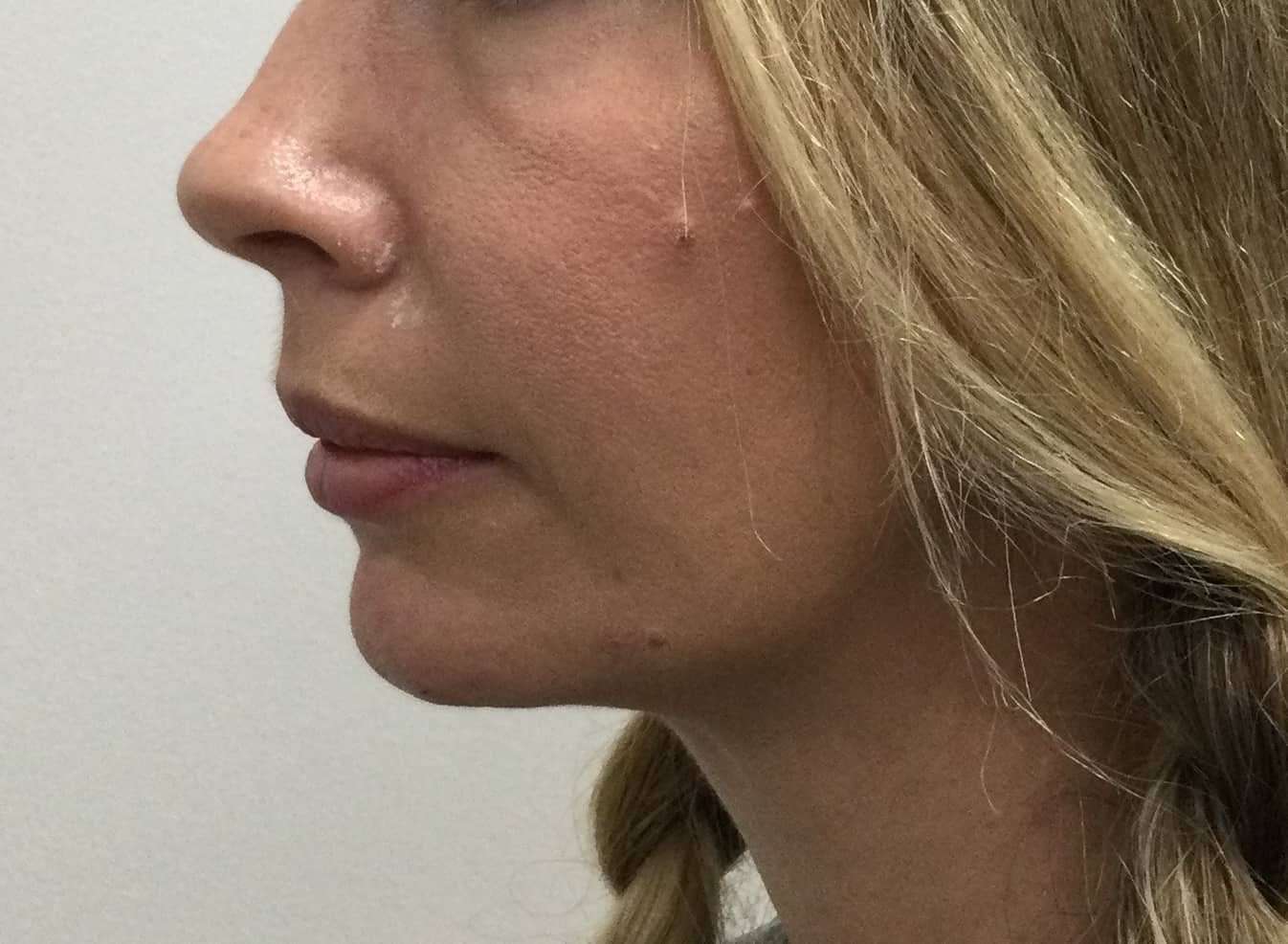 Restylane® Before & After Gallery - Patient 384756 - Image 2