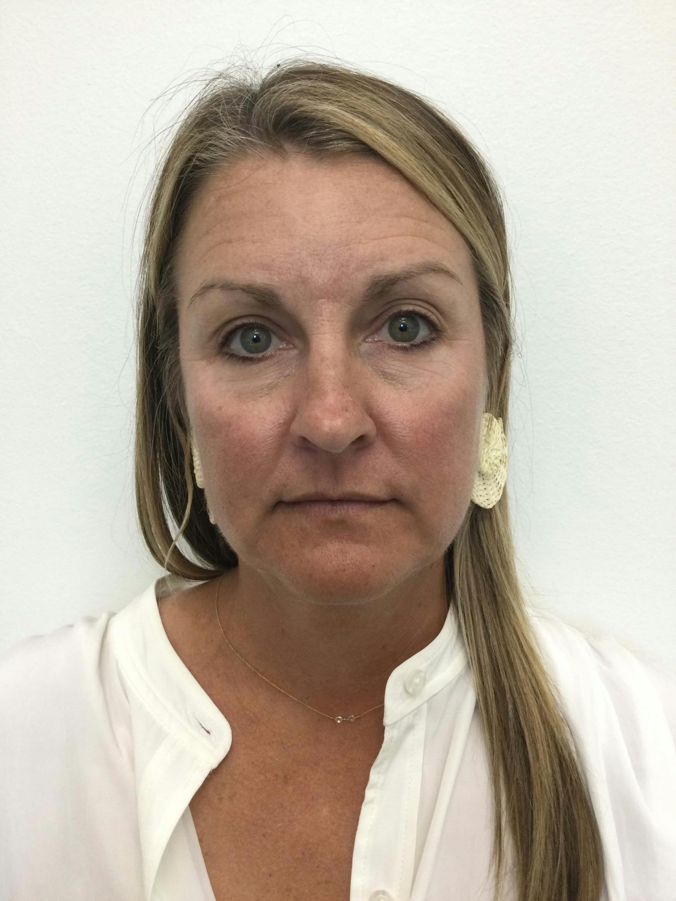 BOTOX® Before & After Gallery - Patient 376072 - Image 1