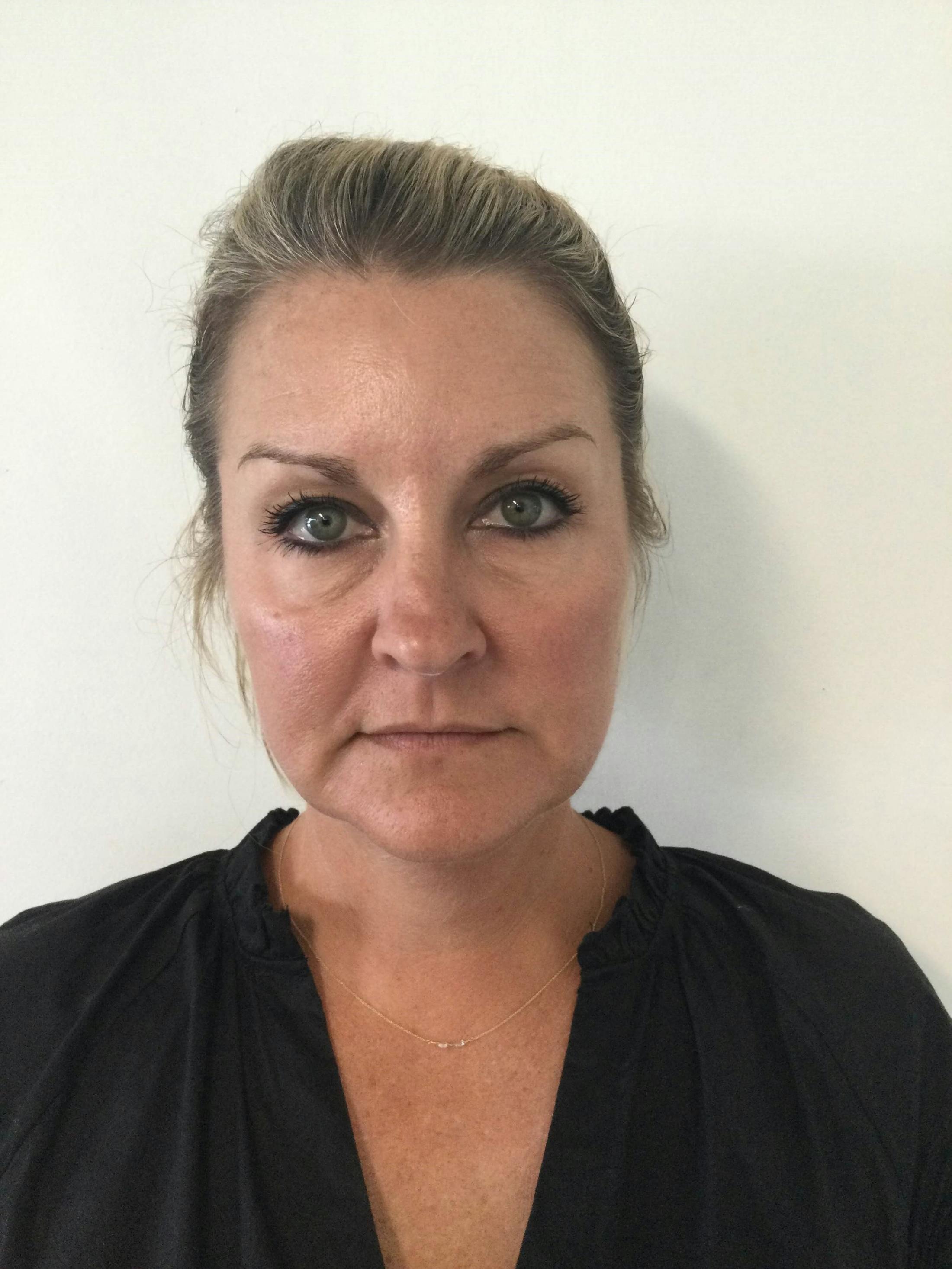 BOTOX® Before & After Gallery - Patient 376072 - Image 2