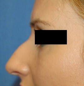 Voluma® Before & After Gallery - Patient 231553 - Image 1