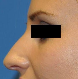 Voluma® Before & After Gallery - Patient 231553 - Image 2