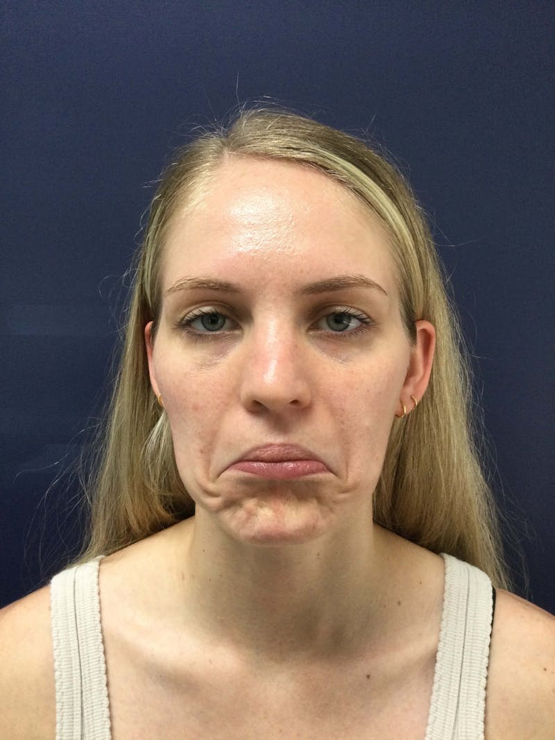 BOTOX® Before & After Gallery - Patient 626307 - Image 6