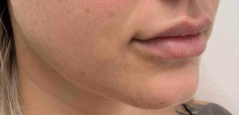 Juvéderm® Before & After Gallery - Patient 129543 - Image 4