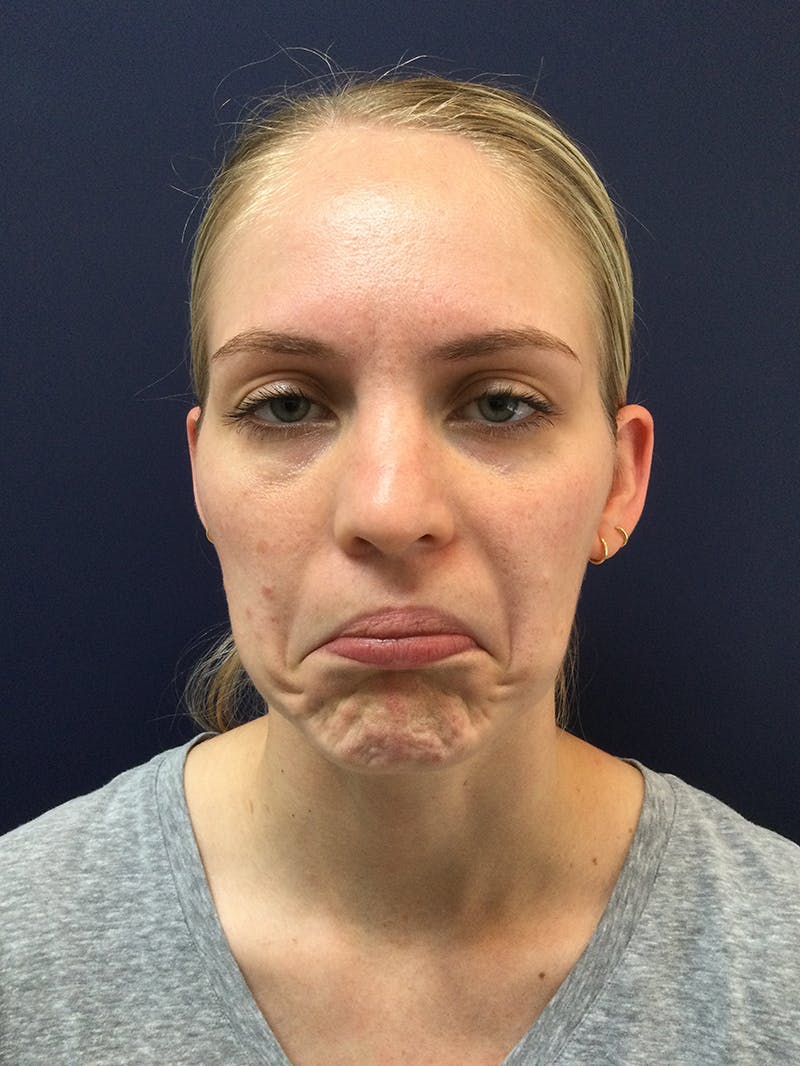 BOTOX® Before & After Gallery - Patient 148954 - Image 1
