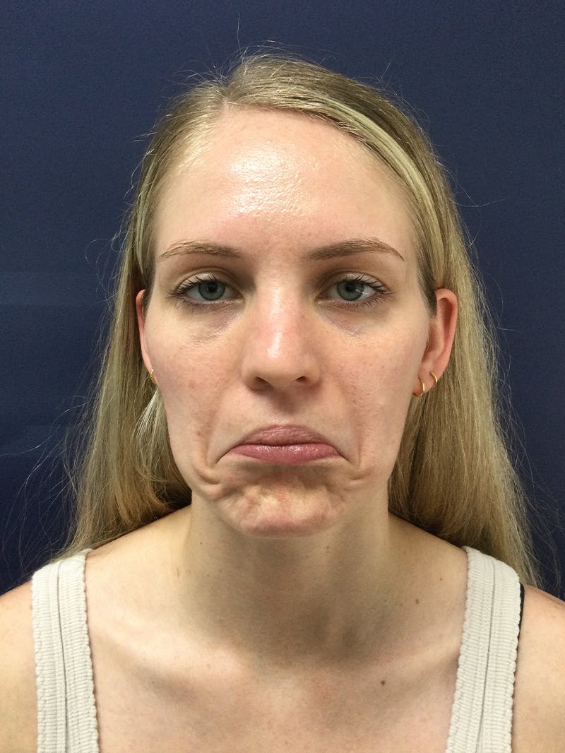 BOTOX® Before & After Gallery - Patient 148954 - Image 2