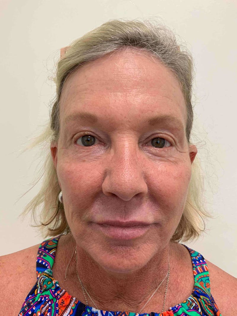 Juvéderm® Before & After Gallery - Patient 408545 - Image 1