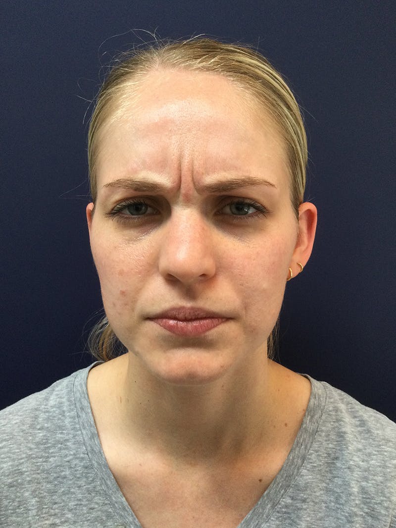 BOTOX® Before & After Gallery - Patient 148954 - Image 3
