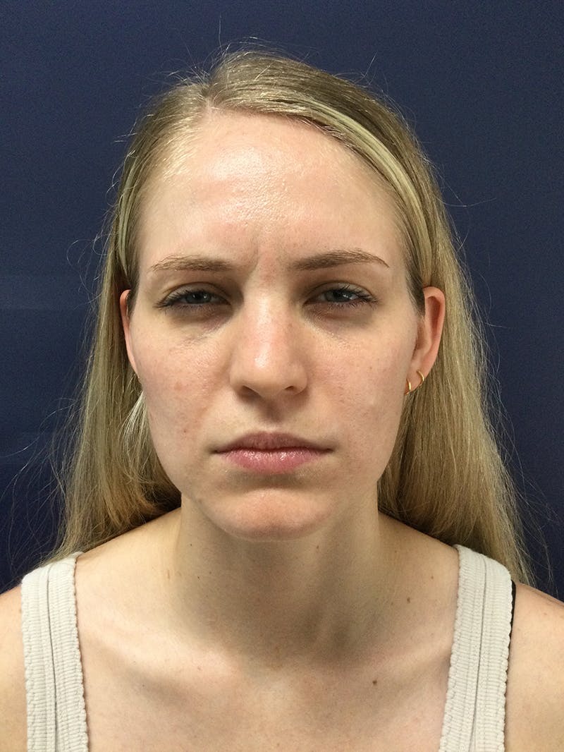 BOTOX® Before & After Gallery - Patient 148954 - Image 4