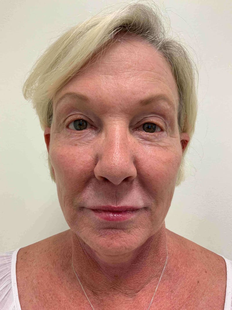 Juvéderm® Before & After Gallery - Patient 408545 - Image 2