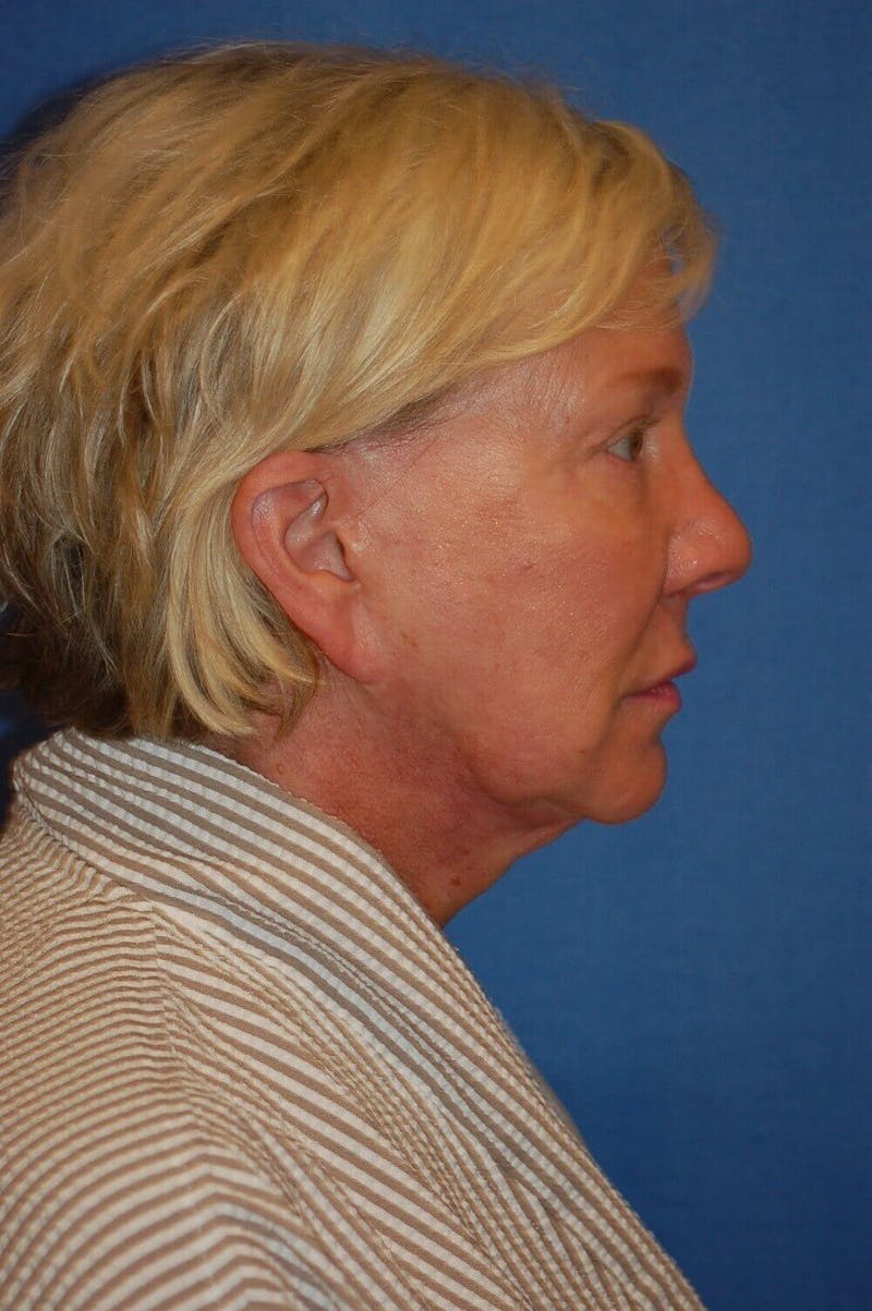 Juvéderm® Before & After Gallery - Patient 408545 - Image 3