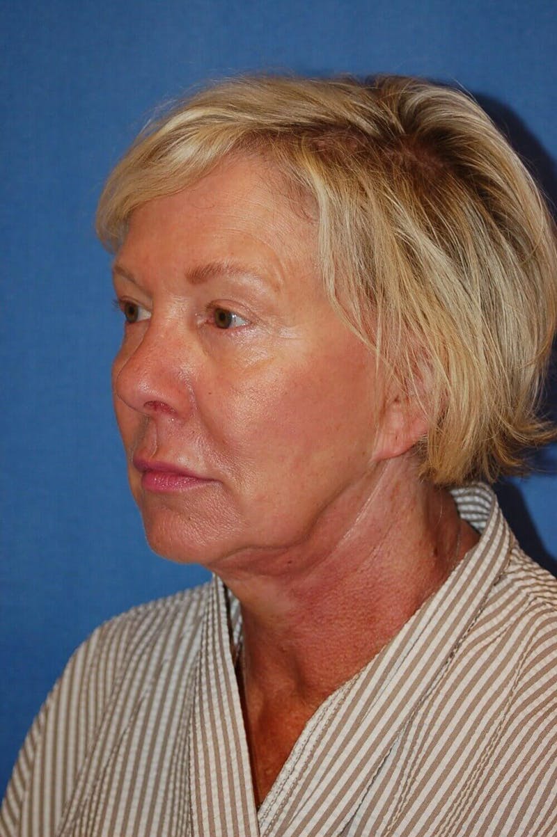Juvéderm® Before & After Gallery - Patient 408545 - Image 5