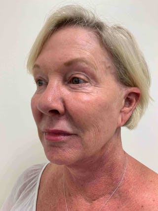 Juvéderm® Before & After Gallery - Patient 408545 - Image 6