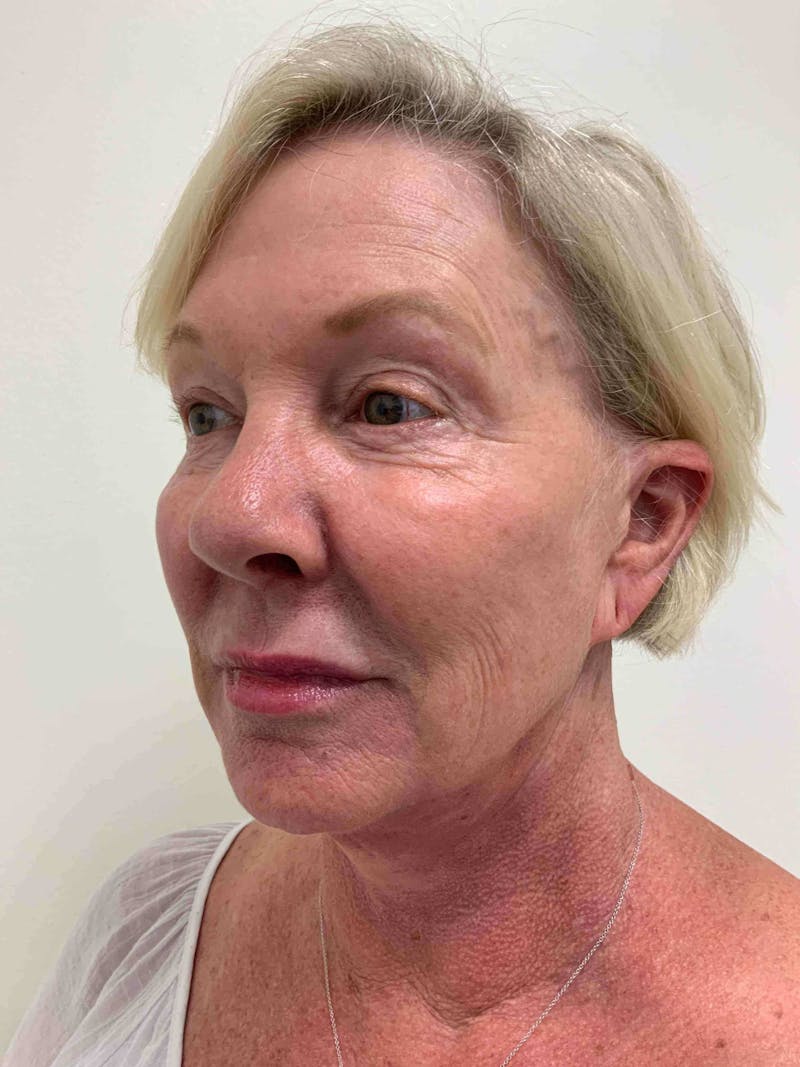 Juvéderm® Before & After Gallery - Patient 408545 - Image 6