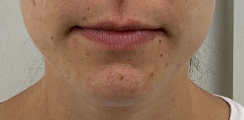 Juvéderm® Before & After Gallery - Patient 145673 - Image 1