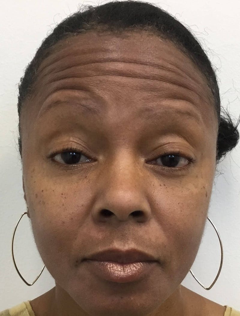 BOTOX® Before & After Gallery - Patient 327052 - Image 1
