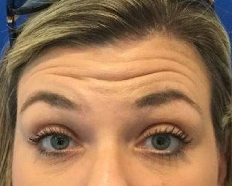 BOTOX® Before & After Gallery - Patient 158987 - Image 1
