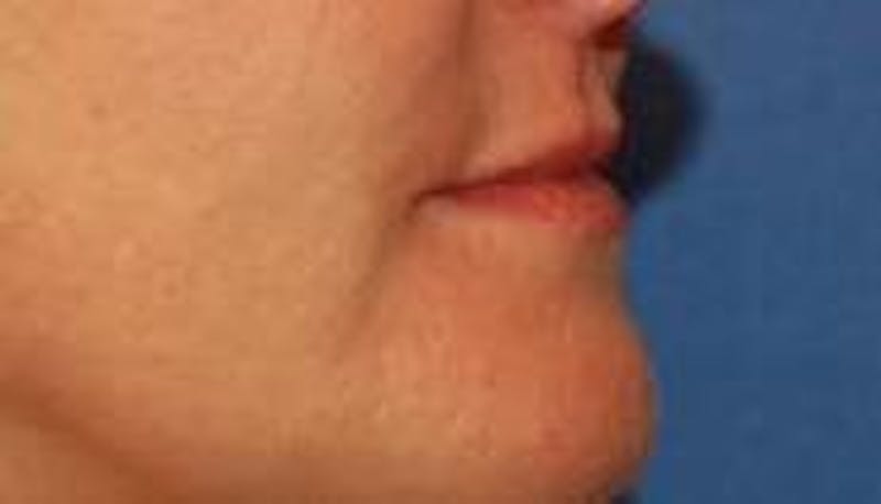 BOTOX® Before & After Gallery - Patient 385940 - Image 3