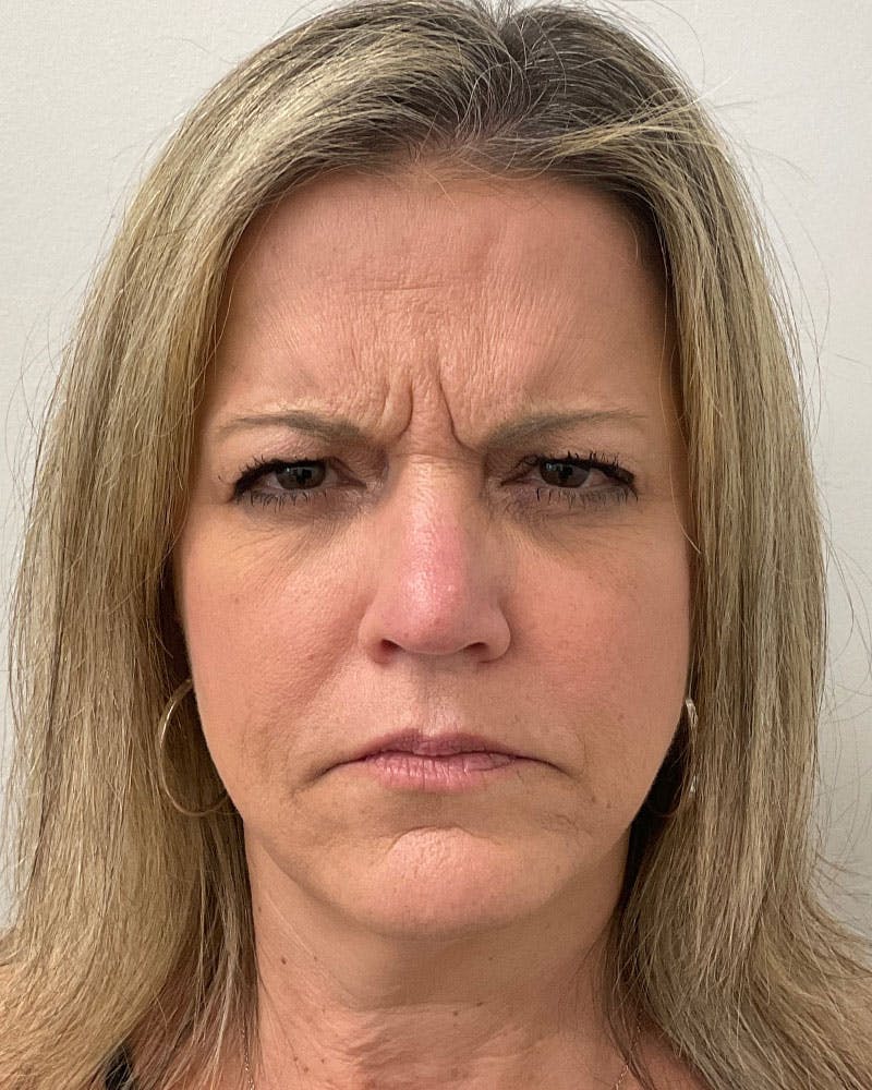 BOTOX® Before & After Gallery - Patient 958131 - Image 3