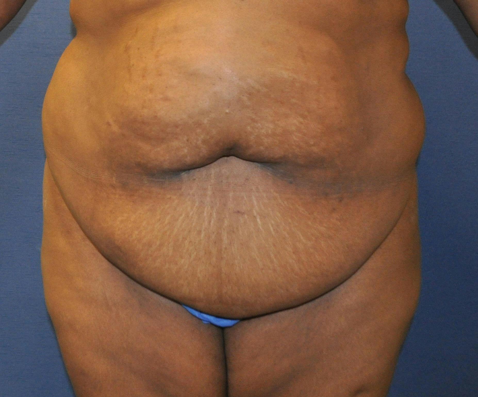 Dr. Erez Sternberg Before & After Gallery - Patient 763217 - Image 1