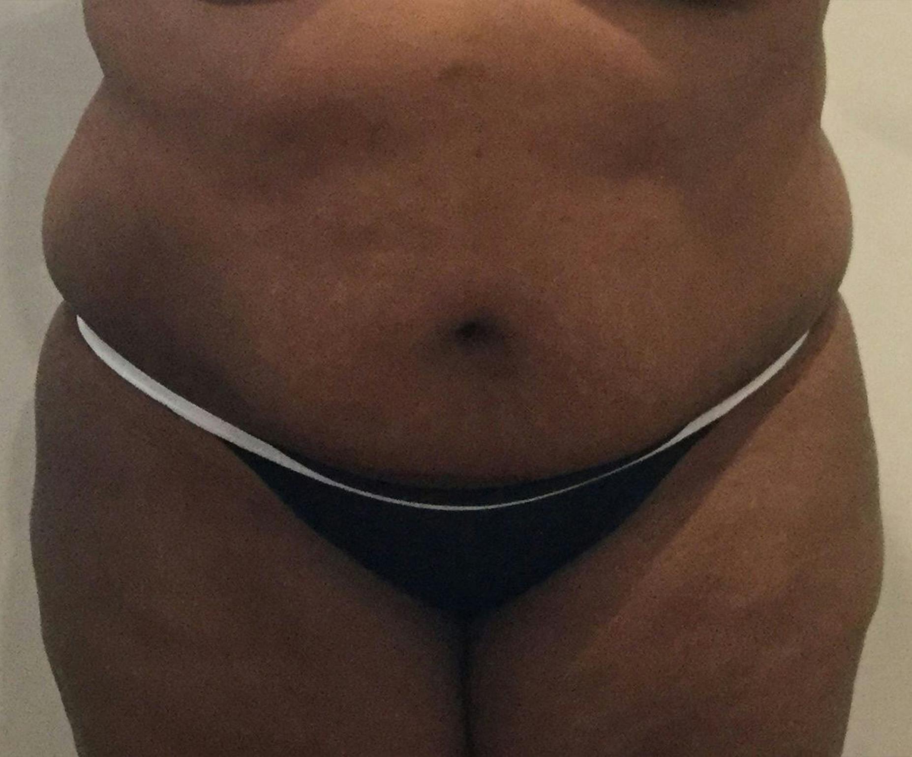 Dr. Erez Sternberg Before & After Gallery - Patient 763217 - Image 2