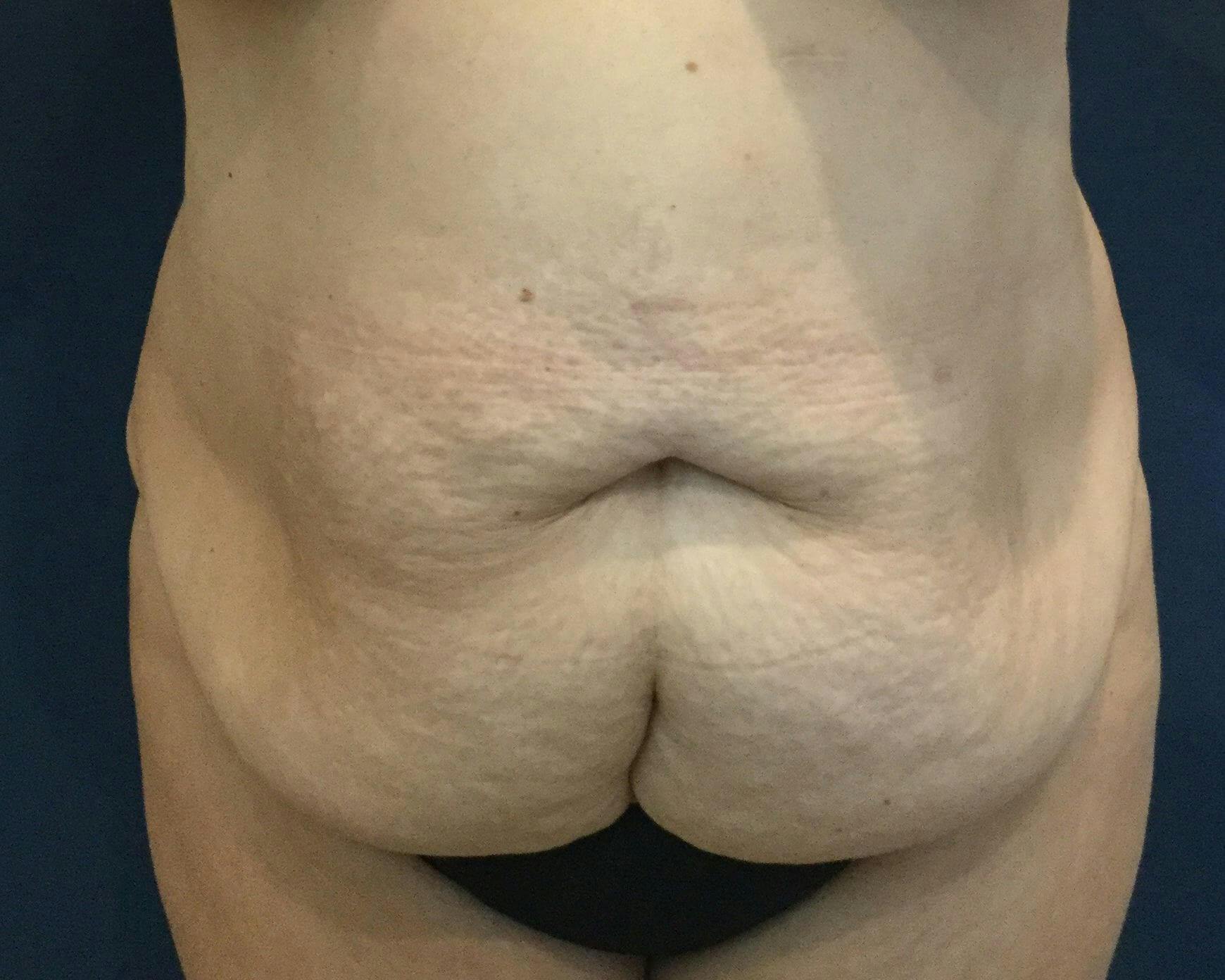 Dr. Erez Sternberg Before & After Gallery - Patient 279883 - Image 1