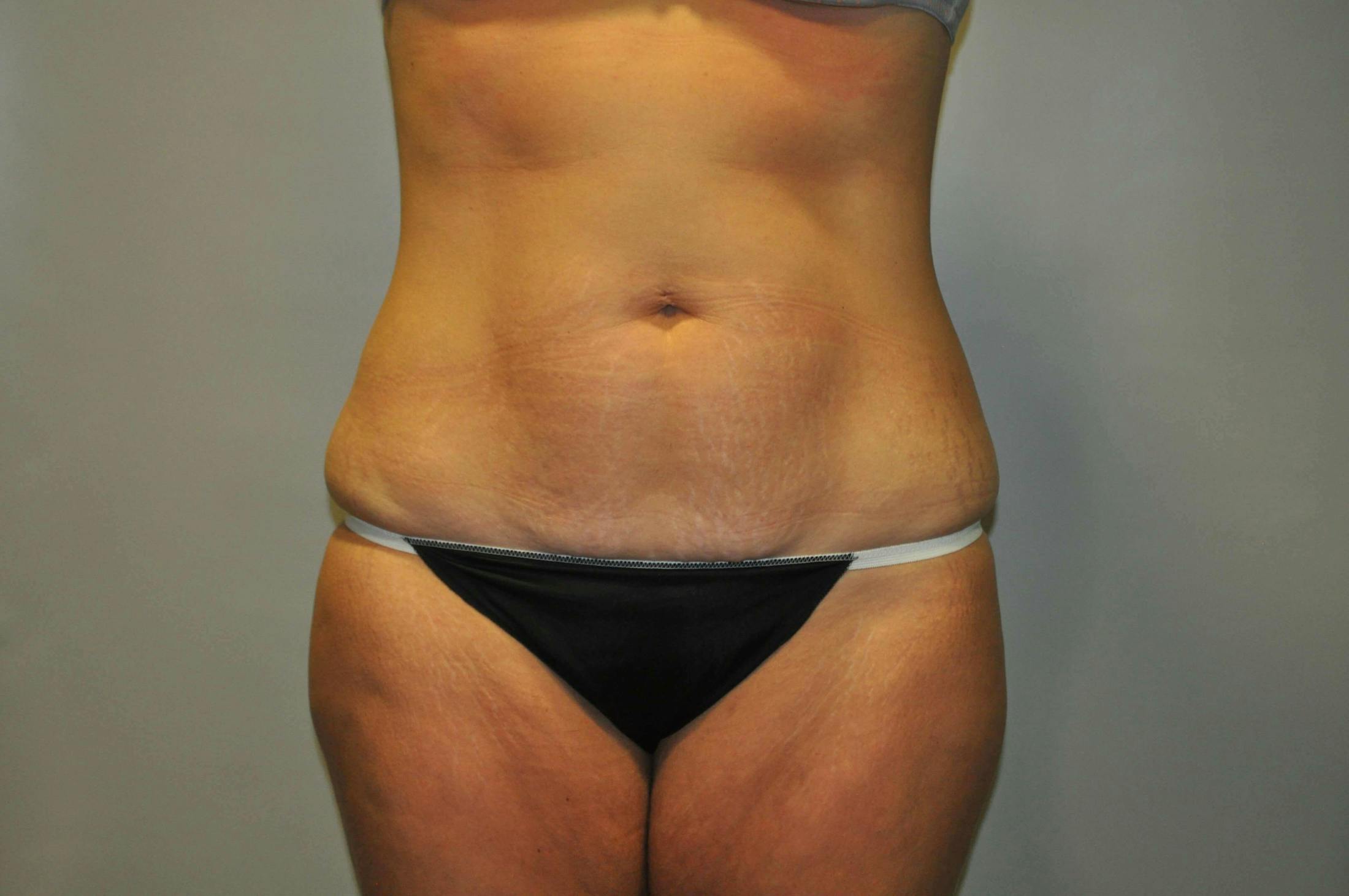 Dr. Erez Sternberg Before & After Gallery - Patient 256028 - Image 1