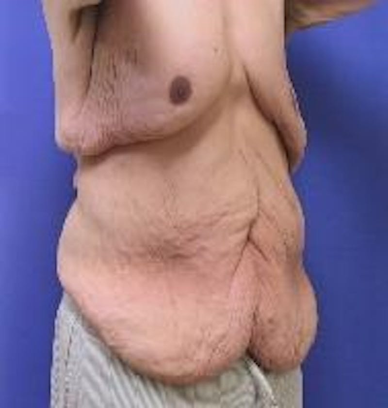 Dr. Cayce Rumsey Before & After Gallery - Patient 215348 - Image 1