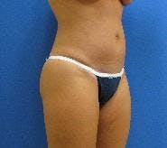 Dr. Cayce Rumsey Before & After Gallery - Patient 291116 - Image 2